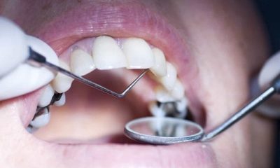 Temporary Dental Filling